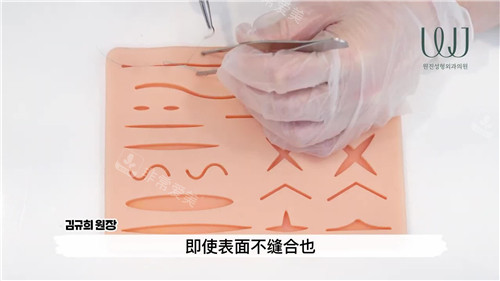 視頻演示縫合方法 視頻演示縫合方法