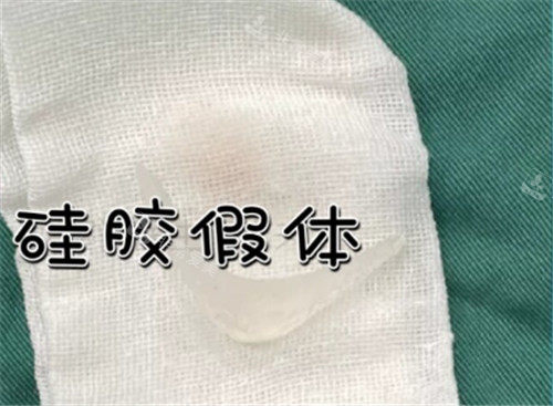下巴硅膠假體照片 下巴硅膠假體照片