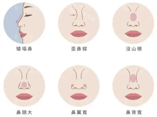 各类鼻型示意图