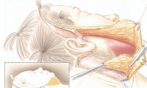 拉皮手术切口展示图