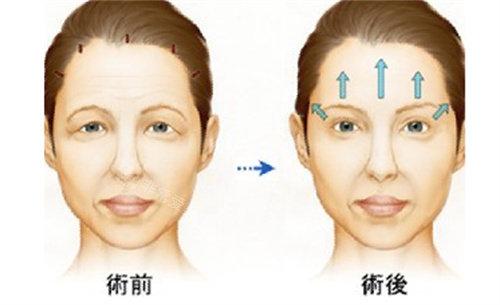 拉皮手術(shù)前后對比圖