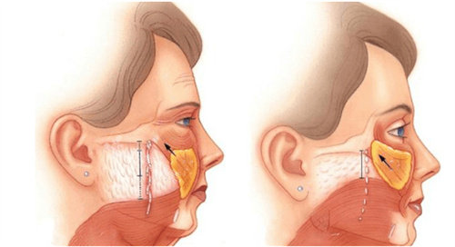 年轻时的面颊组织与衰老面部组织对比图