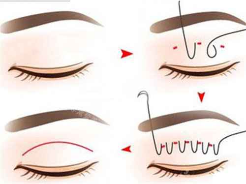 双眼皮过程图