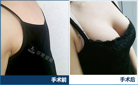 歌柔飛胸部手術(shù)圖片 歌柔飛胸部手術(shù)圖片