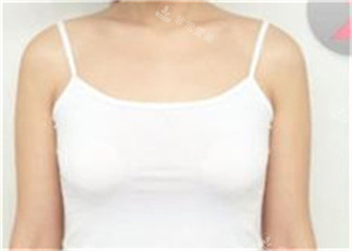 韩国COOKI整形医院胸部填充对比图术前