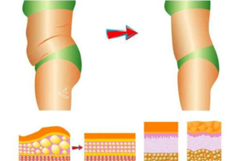 腰腹吸脂前后对比照