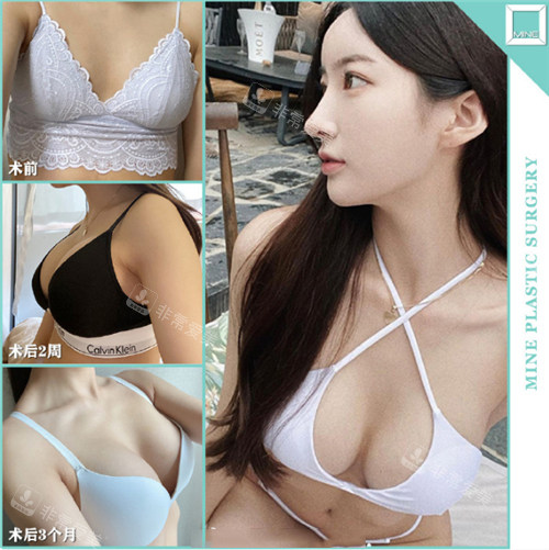 韓國麥恩整形隆胸對比照 韓國麥恩整形隆胸對比照