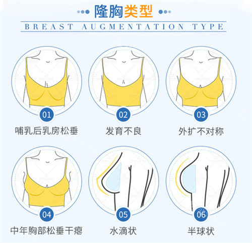 隆胸类型展示图