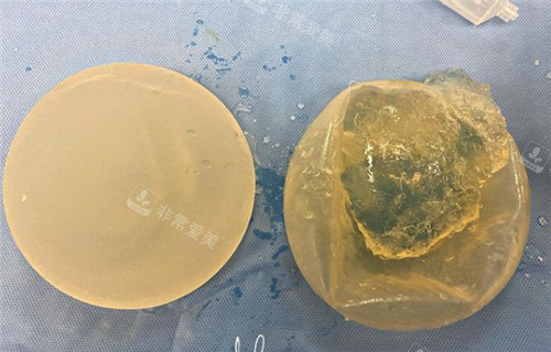 隆胸假體破裂取出 隆胸假體破裂取出