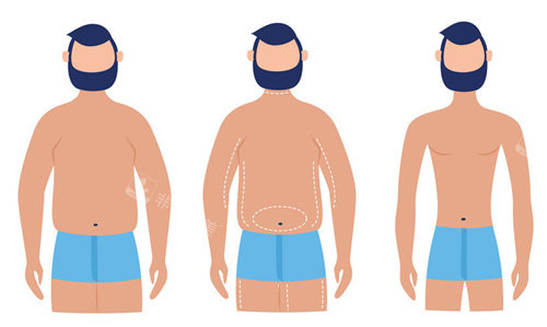 男性威塑吸脂可以改善腰腹肌肉