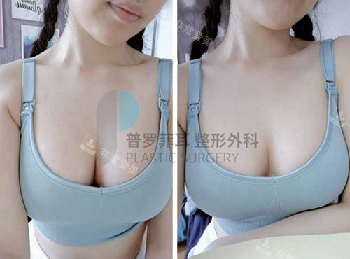 普羅菲耳整形隆胸術(shù)后圖 普羅菲耳整形隆胸術(shù)后圖