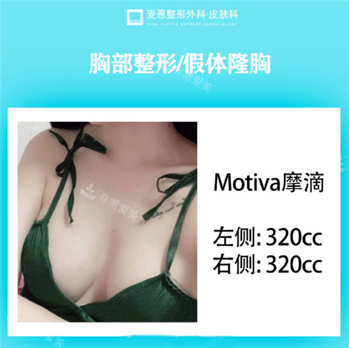 Woobillybra,Woobilly 胸罩,Woobilly 深罩杯胸罩,隱藏背部脂肪與塑身衣合併