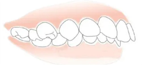 牙齿矫正前图
