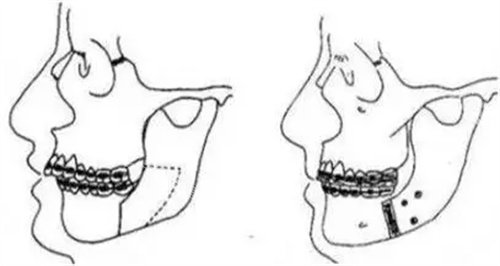 科普先做正畸还是正颌？正颌手术还有多少人不了解？