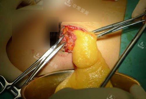 奧美定取出手術(shù)照片 奧美定取出手術(shù)照片