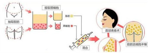 脂肪填充过程图