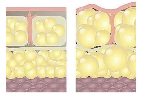 脂肪填充图片