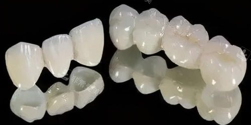 烤瓷牙示意圖 烤瓷牙示意圖