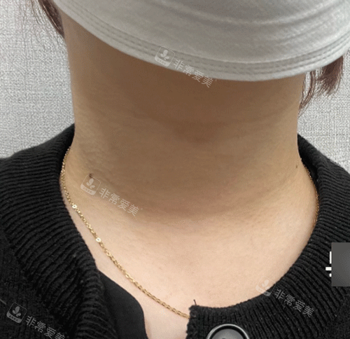 颈纹手术前照片