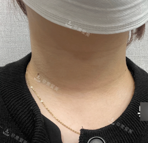 頸紋手術(shù)前照片