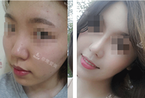 韓國will整形鼻子整形圖