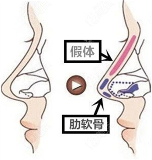 假体和肋软骨展示图