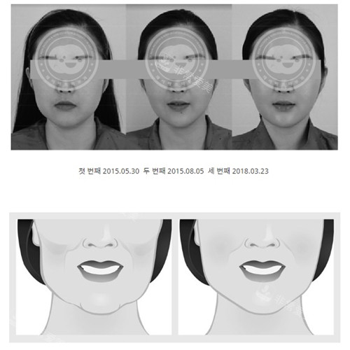 韩国JF皮肤科面部抗衰对比