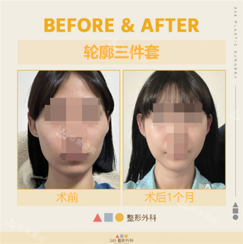 韓國(guó)345整形外科輪廓三件套對(duì)比圖 韓國(guó)345整形外科輪廓三件套對(duì)比圖