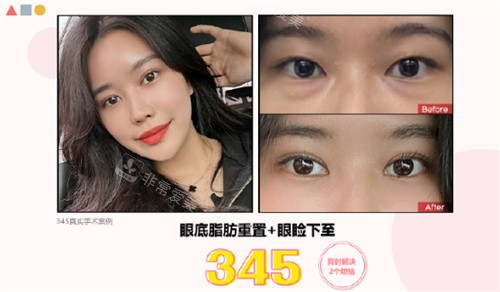 韓國(guó)345整形外科眼部整形前后圖 韓國(guó)345整形外科眼部整形前后圖