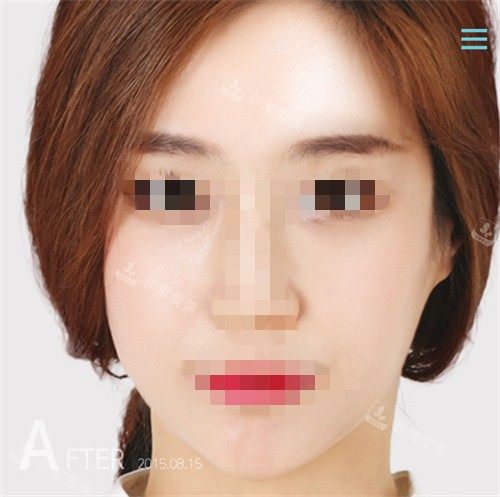 釜山DH整形外科醫(yī)院術后圖