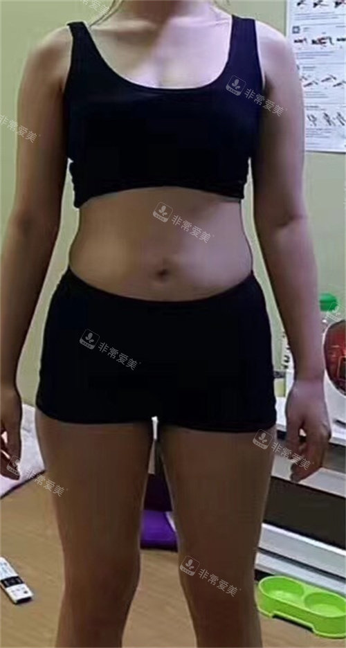 韓國(guó)GOOD LINE整形外科術(shù)前圖 韓國(guó)GOOD LINE整形外科術(shù)前圖