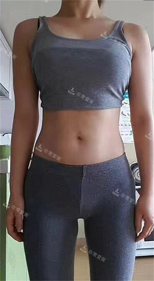韓國(guó)GOOD LINE整形外科術(shù)后圖 韓國(guó)GOOD LINE整形外科術(shù)后圖