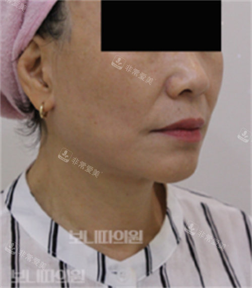 寶妮達(dá)Bonita整形醫(yī)院術(shù)后照 寶妮達(dá)Bonita整形醫(yī)院術(shù)后照