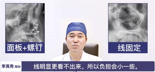 X光片下兩種固定方法對比圖 X光片下兩種固定方法對比圖