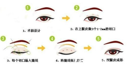 雙眼皮手術(shù)圖