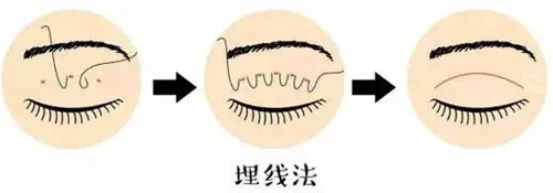 雙眼皮圖片