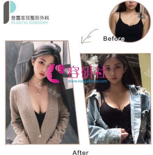 韓國(guó)普羅菲耳整形隆胸前后對(duì)比照 韓國(guó)普羅菲耳整形隆胸前后對(duì)比照