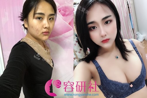 韓國(guó)profile整形假體隆胸前后對(duì)比照 韓國(guó)profile整形假體隆胸前后對(duì)比照
