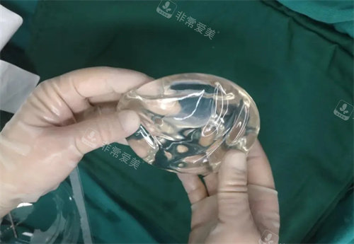 光面假體實(shí)例圖 光面假體實(shí)例圖