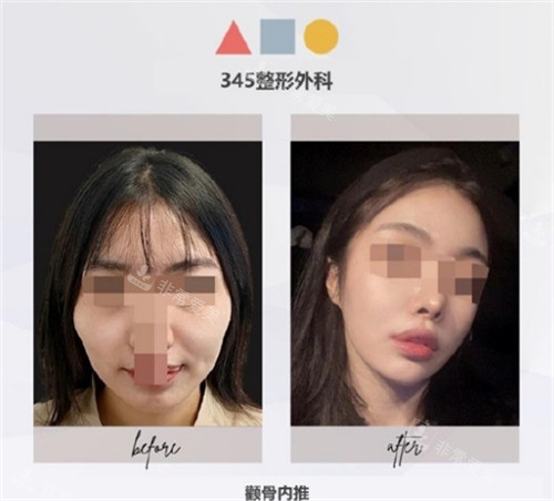 345整形外科顴骨內(nèi)推前后圖 345整形外科顴骨內(nèi)推前后圖