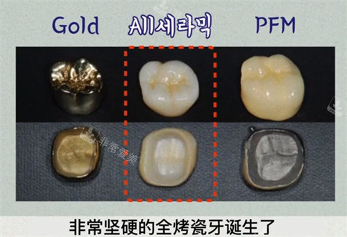 全烤瓷牙的誕生 全烤瓷牙的誕生