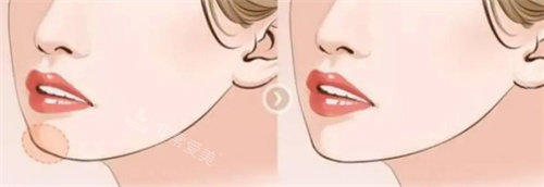 年輕唇部與衰老唇部對比圖 年輕唇部與衰老唇部對比圖
