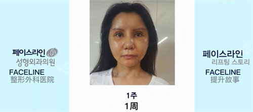 韓國faceline整形醫(yī)術(shù)后一周圖 韓國faceline整形醫(yī)術(shù)后一周圖