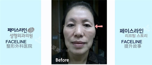 韓國faceline整形醫(yī)面部提升術(shù)前圖 韓國faceline整形醫(yī)面部提升術(shù)前圖