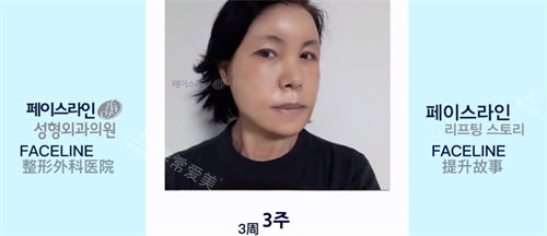 韓國faceline整形醫(yī)術(shù)后三周圖 韓國faceline整形醫(yī)術(shù)后三周圖