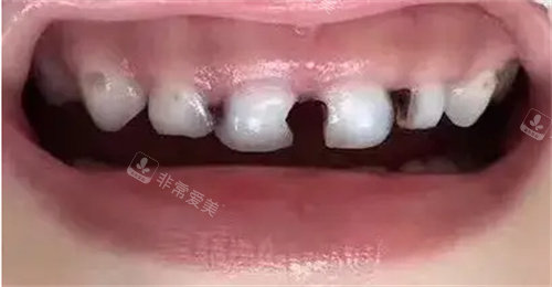 牙齒壞的圖片