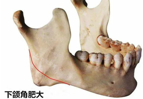 下頜角肥大圖