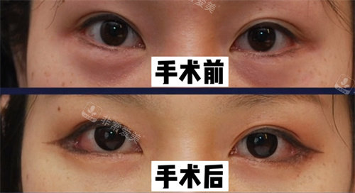 韓國(guó)來麗整形開外眼角手術(shù)正面對(duì)比照 韓國(guó)來麗整形開外眼角手術(shù)正面對(duì)比照