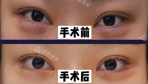 其他醫(yī)院做的開外眼角手術(shù) 其他醫(yī)院做的開外眼角手術(shù)