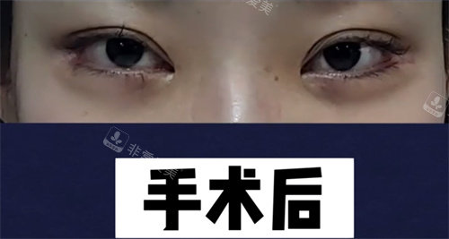 開外眼角手術(shù)后圖片 開外眼角手術(shù)后圖片